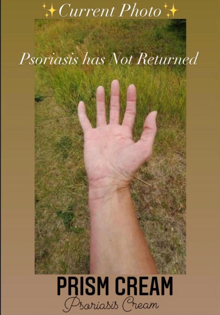 Prism Cream* ~ Psoriasis Cream formulation ~ safe for all skin types ~ cooling sensation ~ All Natural ~ Vegan