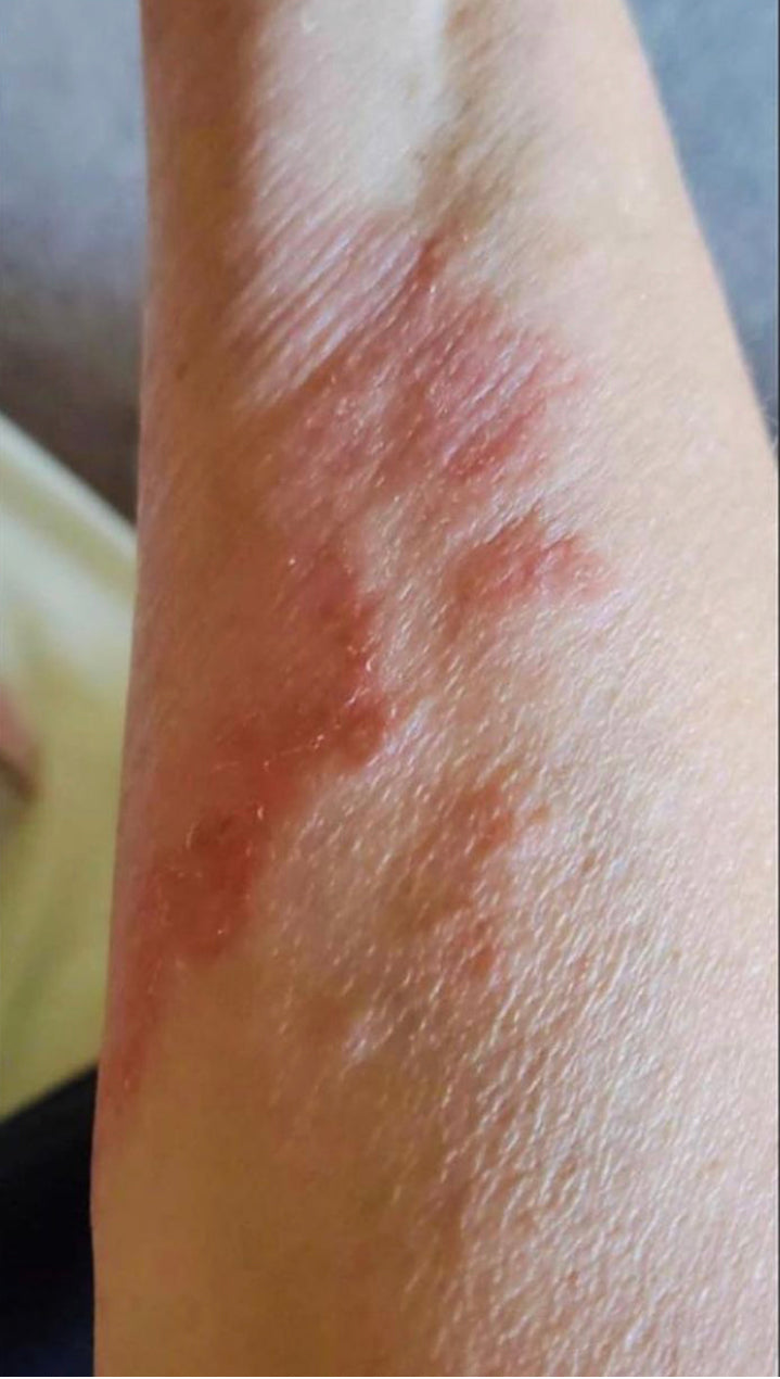 Prism Cream* ~ Psoriasis Cream formulation ~ safe for all skin types ~ cooling sensation ~ All Natural ~ Vegan