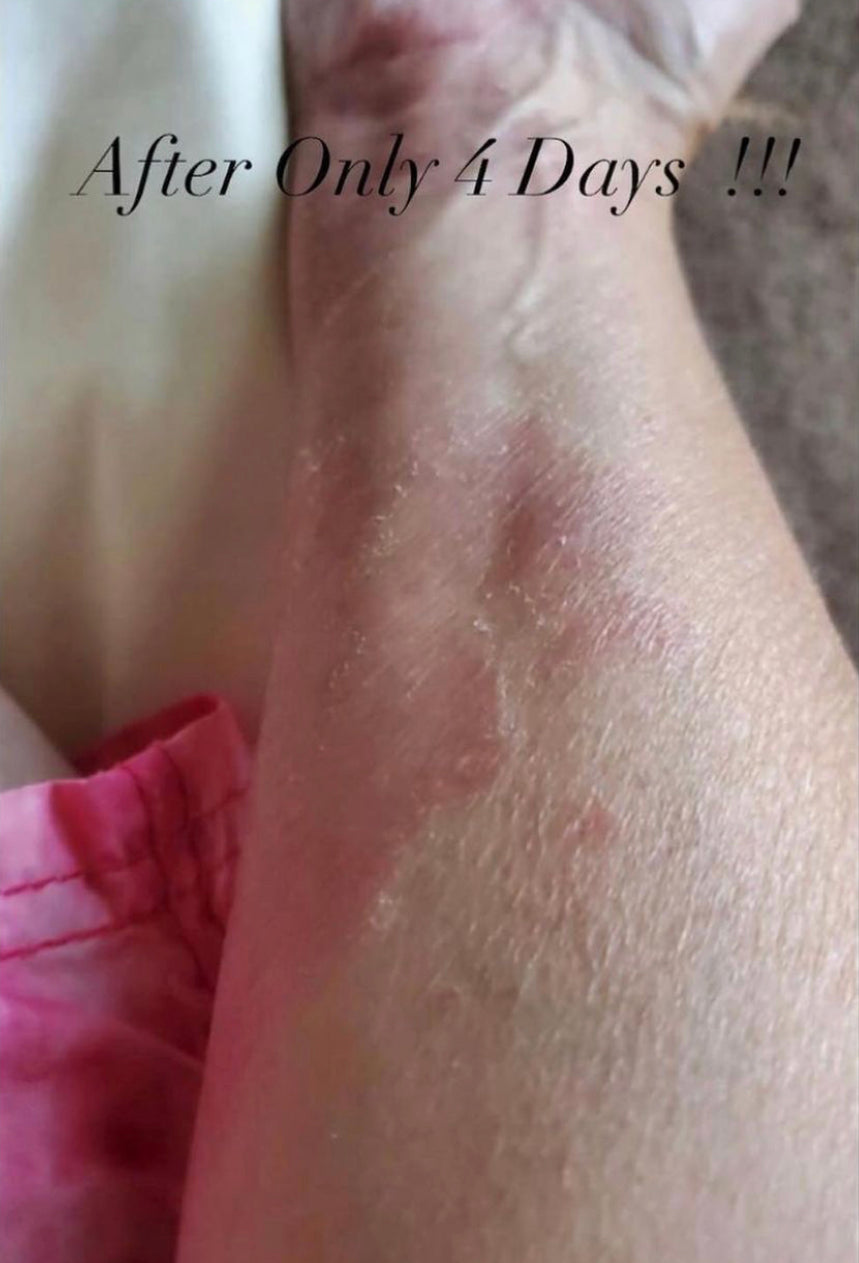 Prism Cream* ~ Psoriasis Cream formulation ~ safe for all skin types ~ cooling sensation ~ All Natural ~ Vegan